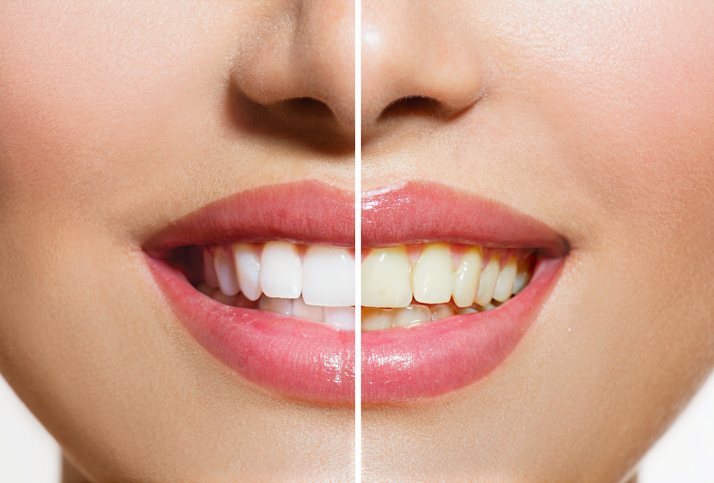 Stained Teeth | Dentist Columbus NE